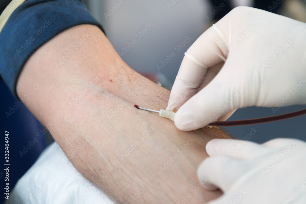 inserts a needle into a vein, close-up, preparation for taking blood test from a vein, mobile blood station. Donation blood to support during a pandemia of coronavirus, blood donor day inserts a needle into a vein, close-up, preparation for taking blood test from a vein, mobile blood station. Donation blood to support during a pandemia of coronavirus, blood donor day