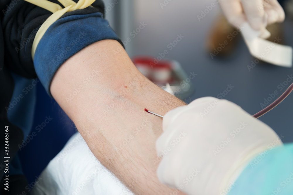 inserts a needle into a vein, close-up, preparation for taking blood test from a vein, mobile blood station. Donation blood to support during a pandemia of coronavirus, blood donor day