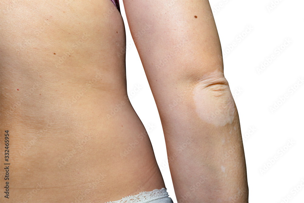 Stains from vitiligo disease on the elbows of a young Caucasian woman, isolated on a white background with a clipping path. Stains from vitiligo disease on the elbows of a young Caucasian woman, isolated on a white background with a clipping path.