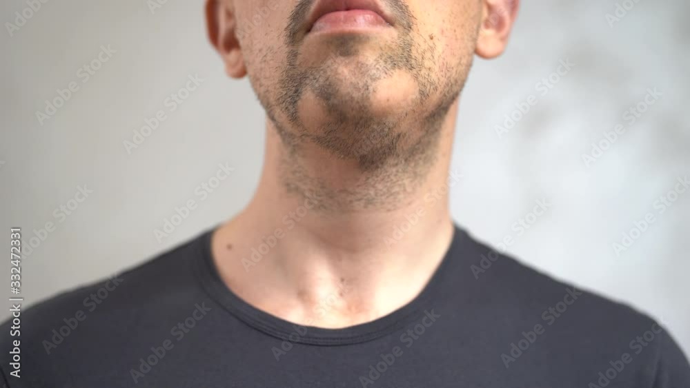 Close up of alopecia on a man's beard Close up of alopecia on a man's beard