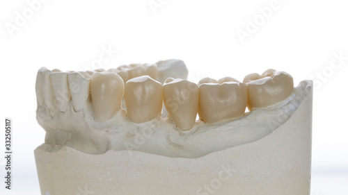 Canvas Print excellent zirconium crowns in the dental model, shot on a white bright backgroun