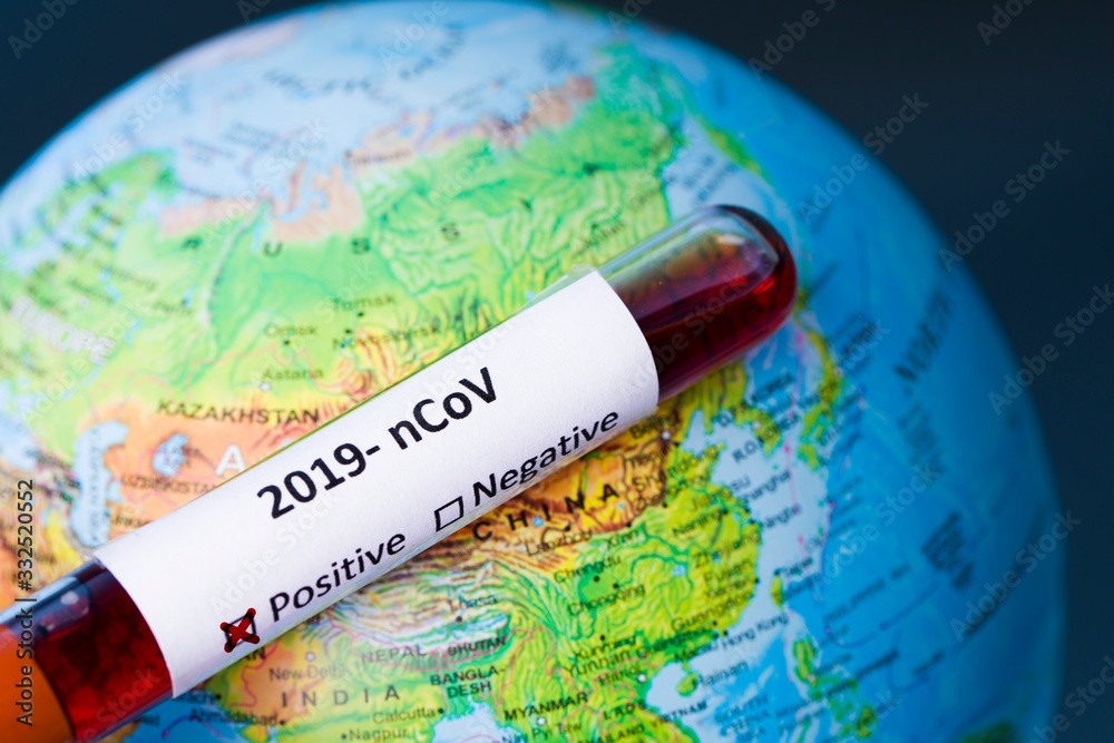 Positive blood test result for the new rapidly spreading Coronavirus, originating in Wuhan, China Coronavirus 2019-nCoV Blood Sample. Corona virus outbreaking. Epidemic virus Respiratory Syndrome.
