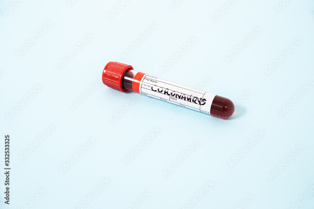 Sample vial for coronavirus testing. Concept of problem with virus, coronavirus, Covid 19 Sars. Performing coronavirus tests, pandemic. Sample vial for coronavirus testing. Concept of problem with virus, coronavirus, Covid 19 Sars. Performing coronavirus tests, pandemic.