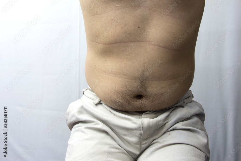 Naklejka premium Fat man Risk of diabetes.