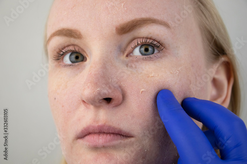 A woman examines dry skin on her face. Peeling, coarsening, discomfort, skin sensitivity. Patient at the appointment of a dermatologist or cosmetologist, selection of cream for dryness photo