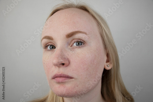 A woman examines dry skin on her face. Peeling, coarsening, discomfort, skin sensitivity. Patient at the appointment of a dermatologist or cosmetologist, selection of cream for dryness