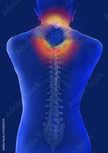 Rücken, Halswirbelsäule, Schmerzzone, Illustration, Computertomographie