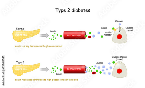 Types 2 of Diabetes Mellitus. Comparison of cell work in diabetes and in a healthy body. photo