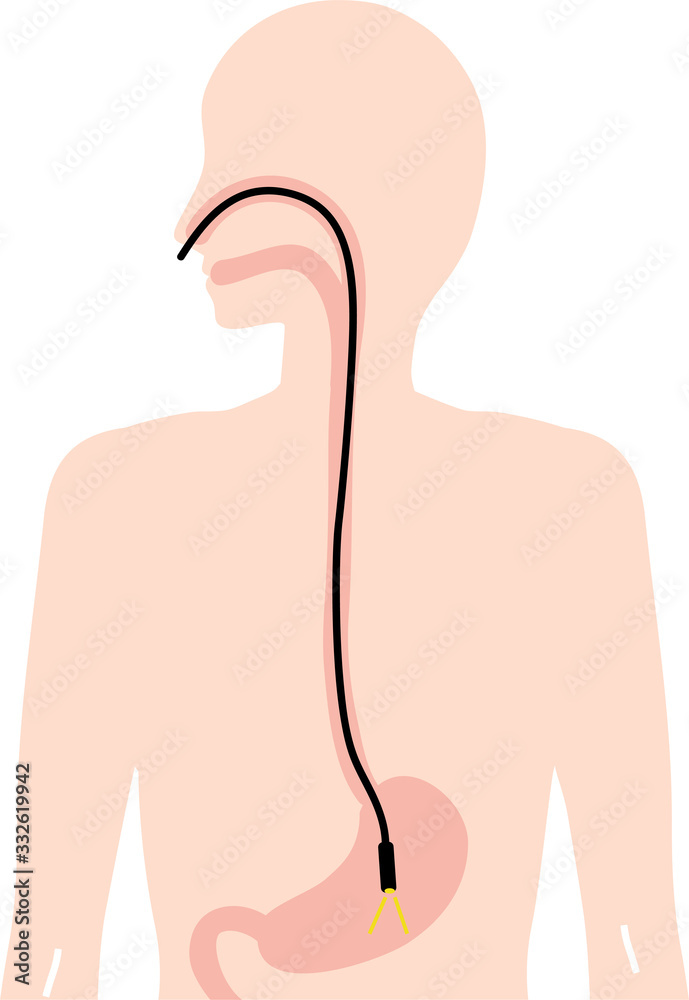 胃カメラ　検査