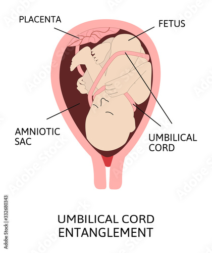 Umbilical cord entanglement. vector illustration of entanglement of umbilical cord around the fetus.