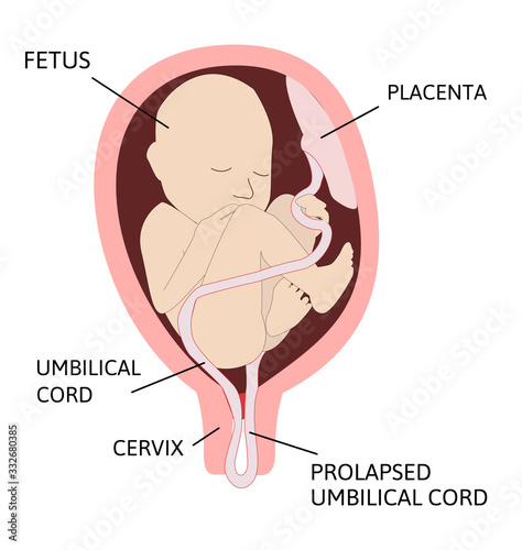 Prolapsed umbilical cord. umbilical cord comes out of the uterus with or before the presenting part of the baby