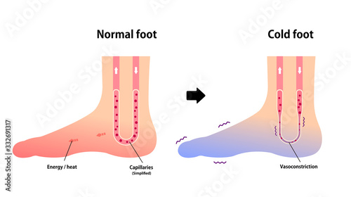 Comparison illustration of normal foot and cold foot ( sensitivity to cold, cold toes)