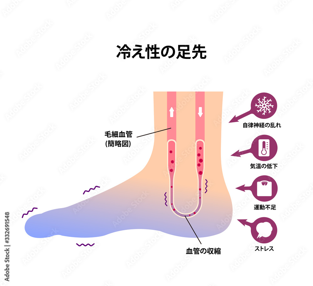 末端冷え性の足イラスト 冷え性の原因 Stock Vector Adobe Stock