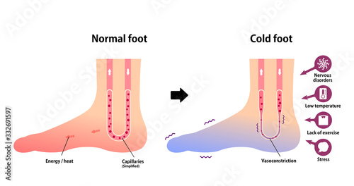 Comparison illustration of normal foot and cold foot ( sensitivity to cold, cold toes)