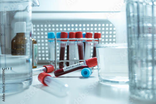 Positive / Negative COVID-19 test tube and laboratory sample of blood testing for diagnosis new Corona virus infection. Epidemic virus Respiratory Syndrome.
