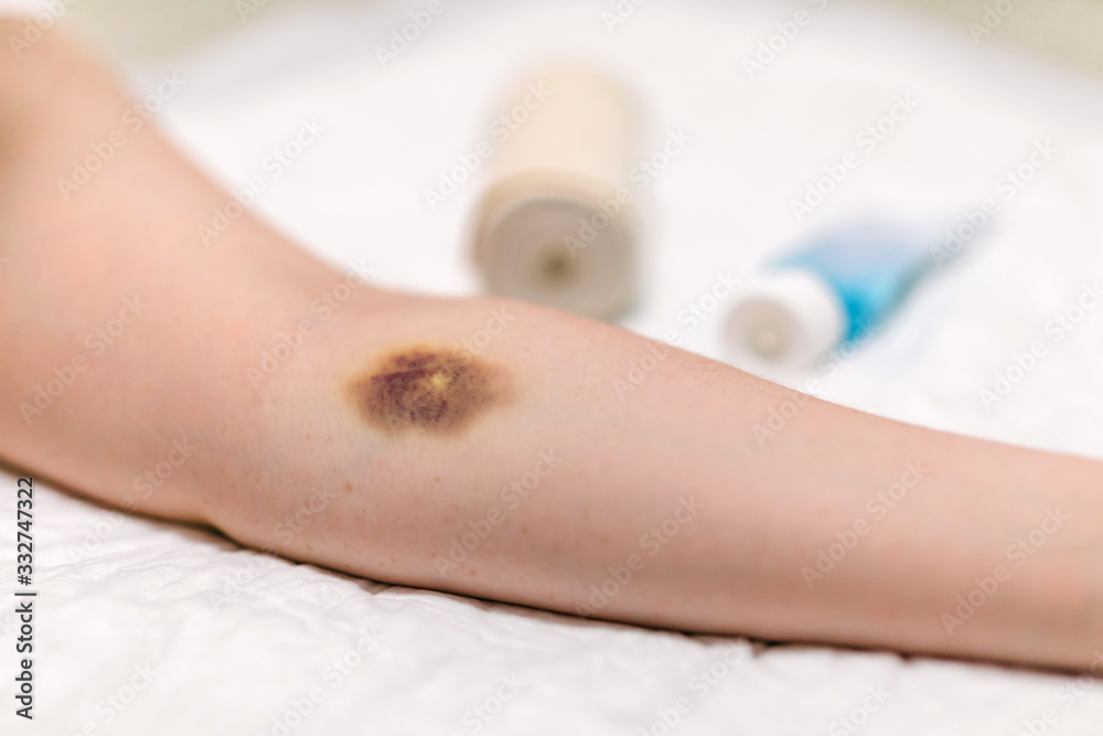 First aid for bruising. Large hematoma bruise on the arm, ointment and bandage First aid for bruising. Large hematoma bruise on the arm, ointment and bandage