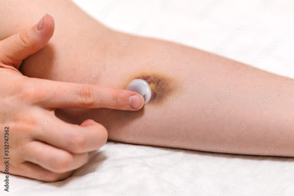 First aid for bruising. Large hematoma bruise on the arm, ointment and bandage First aid for bruising. Large hematoma bruise on the arm, ointment and bandage