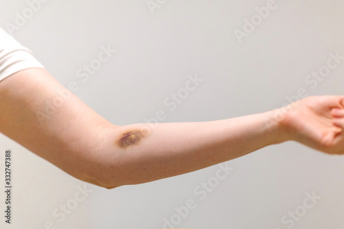 First aid for bruising. Large hematoma bruise on the arm, ointment and bandage photo