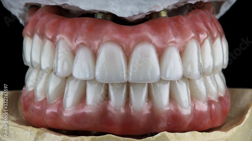high-quality dental prosthesis of the lower and upper jaws on the dental model in the bite