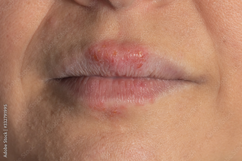 Fototapeta premium Reakcja alergiczna na metal na ustach białej kobiety