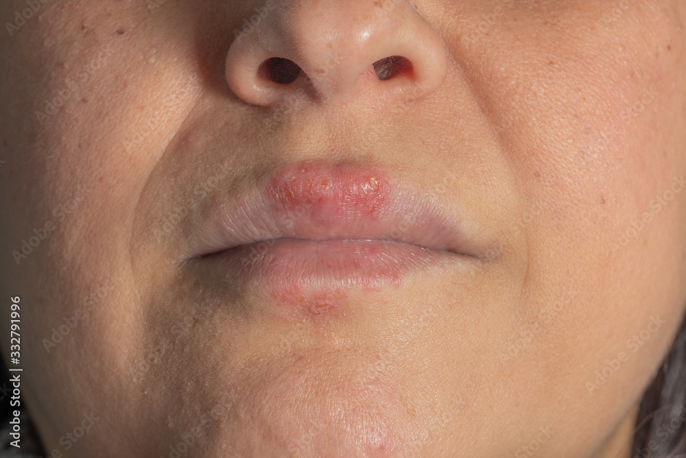 Allergic reaction to metal on the lips of a middle-aged white woman Allergic reaction to metal on the lips of a middle-aged white woman