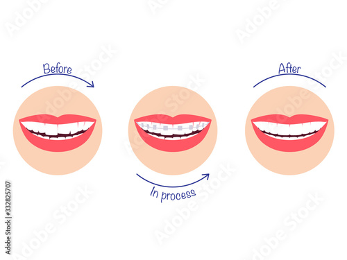 The process of correcting teeth using braces - before and after. Vector illustration