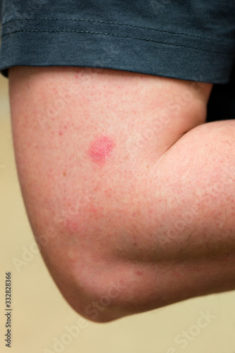 Wallpaper Mural An eczema bearing on a Caucasian hand in a biceps area. Torontodigital.ca