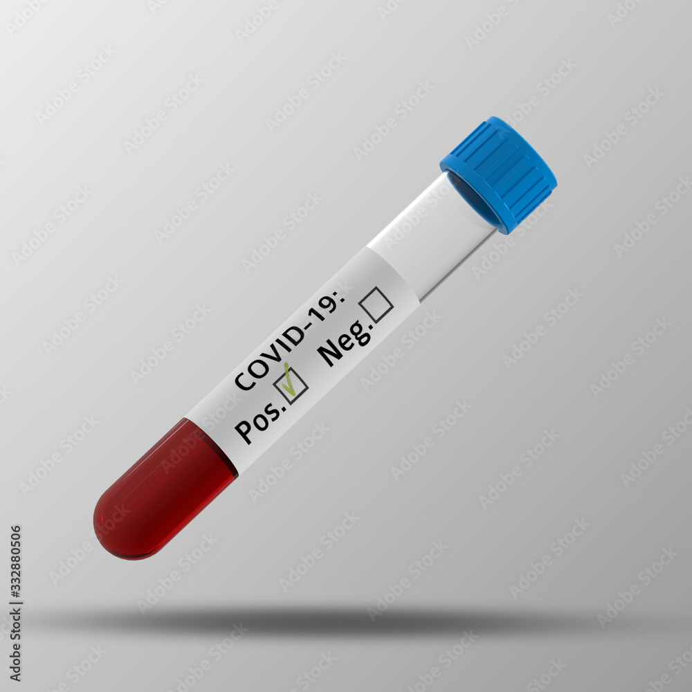 Test tube icon set with COVID-19 coronavirus test positive / Positive blood test result for the new rapidly spreading Coronavirus, originating in Wuhan, China Test tube icon set with COVID-19 coronavirus test positive / Positive blood test result for the new rapidly spreading Coronavirus, originating in Wuhan, China