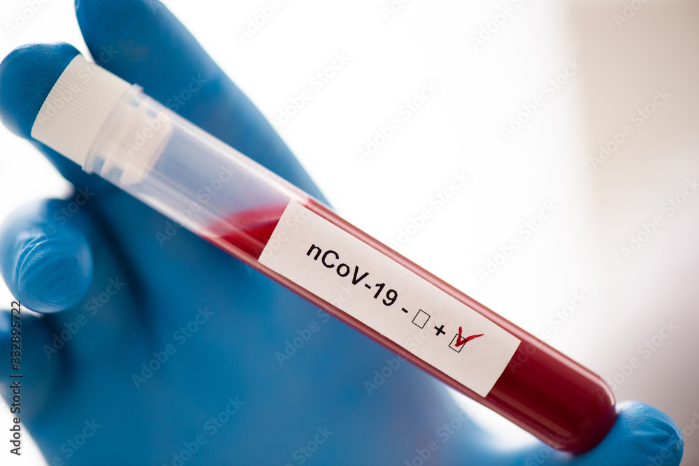 Closeup of a test tube with a blood sample in hand. Rubber glove. Diagnosis of coronavirus Covid-19