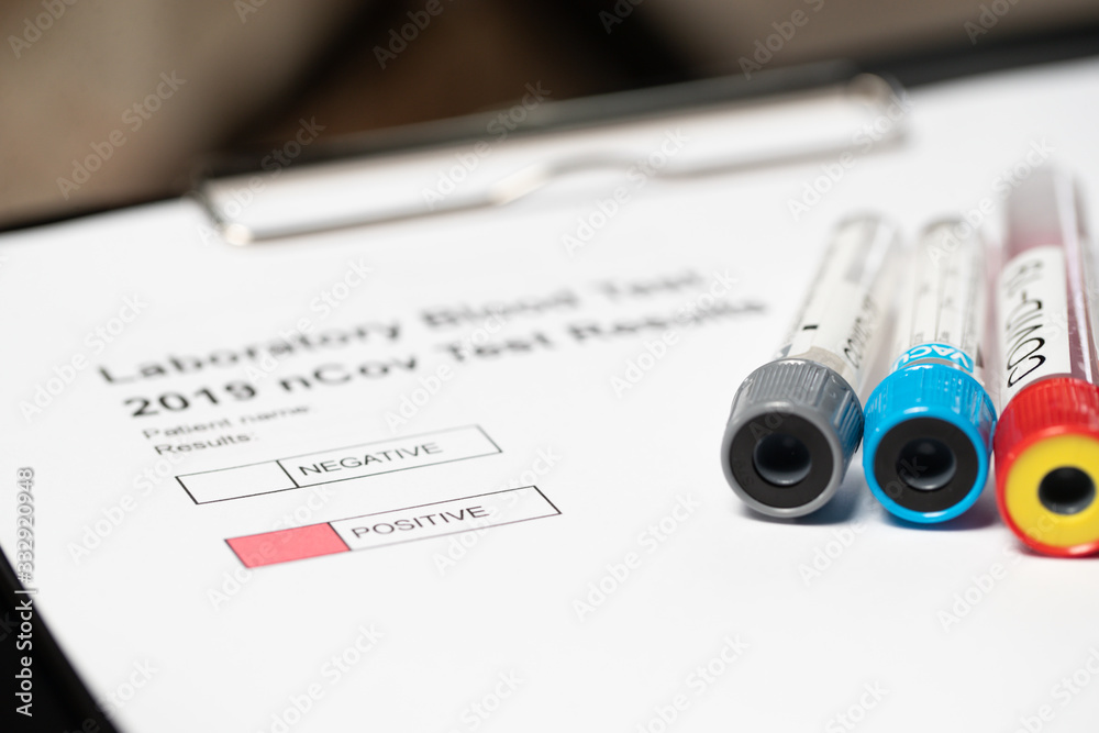 Laboratory results for nCov - 19 positive negative Laboratory results for nCov - 19 positive negative