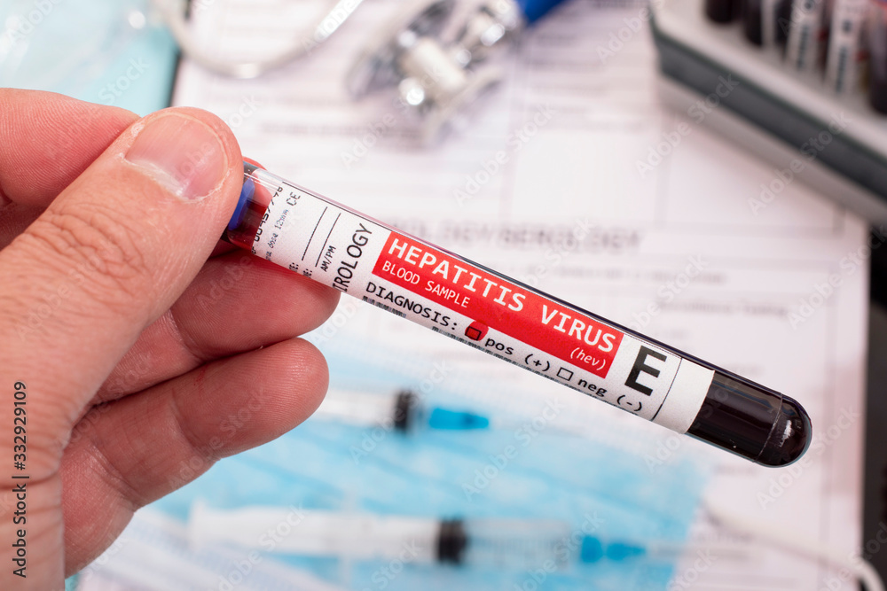 Fototapeta premium Blood samples with infected virus