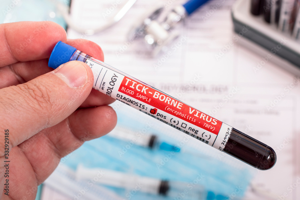 Fototapeta premium Blood samples with infected virus