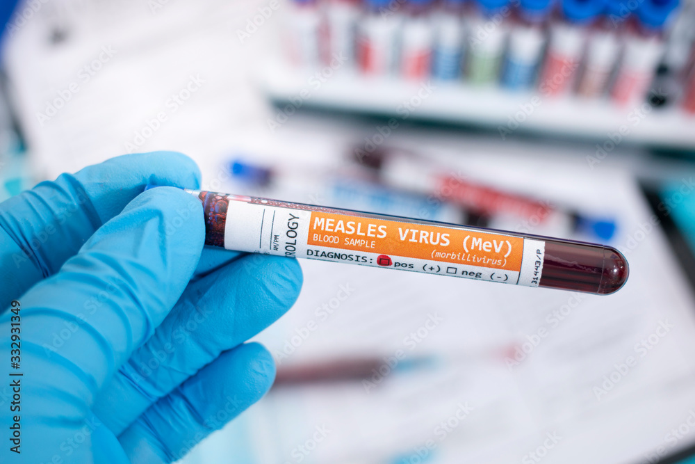 Fototapeta premium Blood samples with infected virus