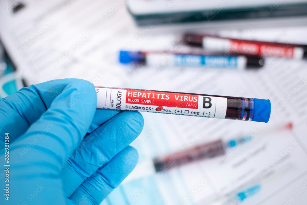 Fototapeta premium Blood samples with infected virus