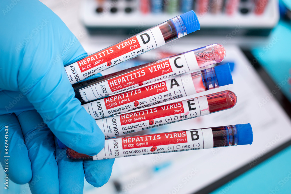Fototapeta premium Blood samples with infected virus