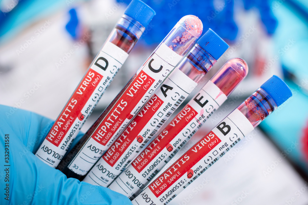 Fototapeta premium Blood samples with infected virus