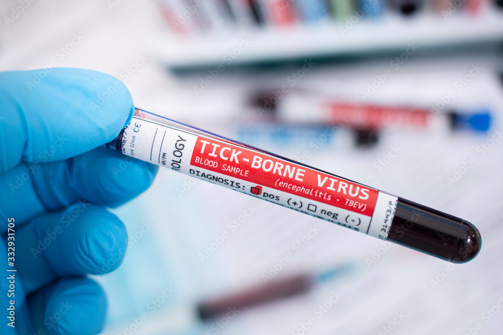 Fototapeta premium Blood samples with infected virus
