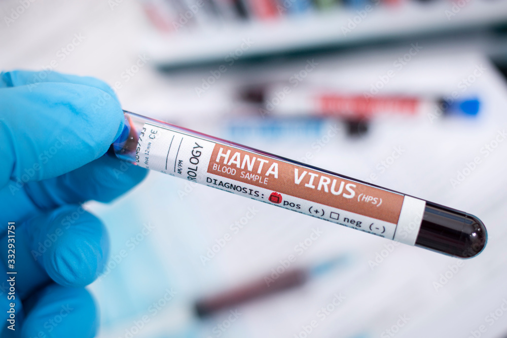 Fototapeta premium Blood samples with infected virus