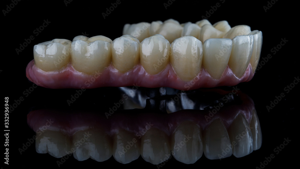 aesthetic dental ceramic prosthesis with pink gum, side view on chewing teeth aesthetic dental ceramic prosthesis with pink gum, side view on chewing teeth