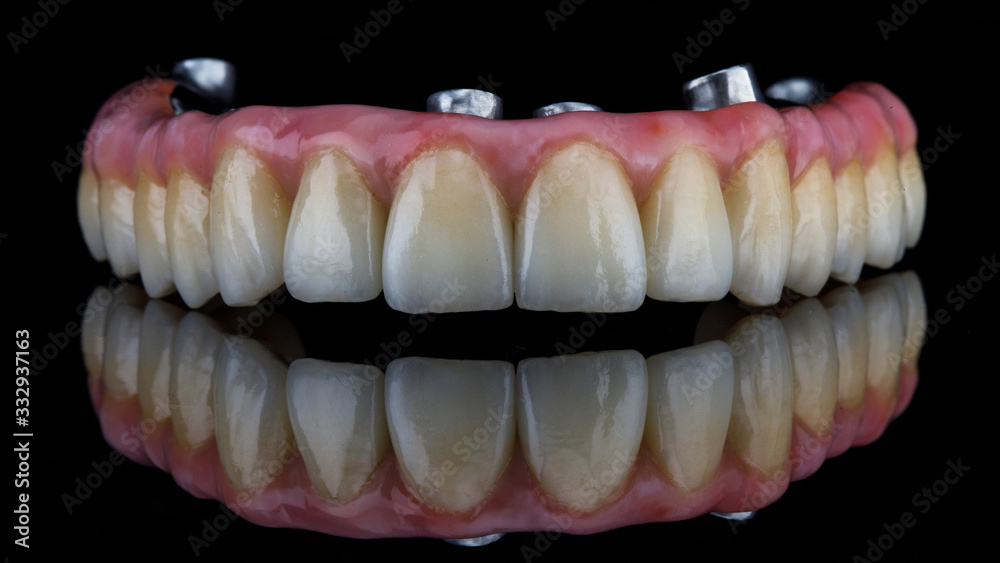 dental prosthesis made of titanium with beautiful and high-quality ceramic or zircon crowns, shot on black glass with reflection dental prosthesis made of titanium with beautiful and high-quality ceramic or zircon crowns, shot on black glass with reflection
