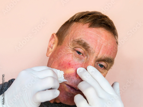 Demodecosis of the face. A man in gloves does the treatment of facial skin with medications. Prevention and treatment of skin diseases. photo