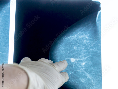 Mammography. The doctor's hand holding the pictures. The doctor examines the pictures in the patient's room.