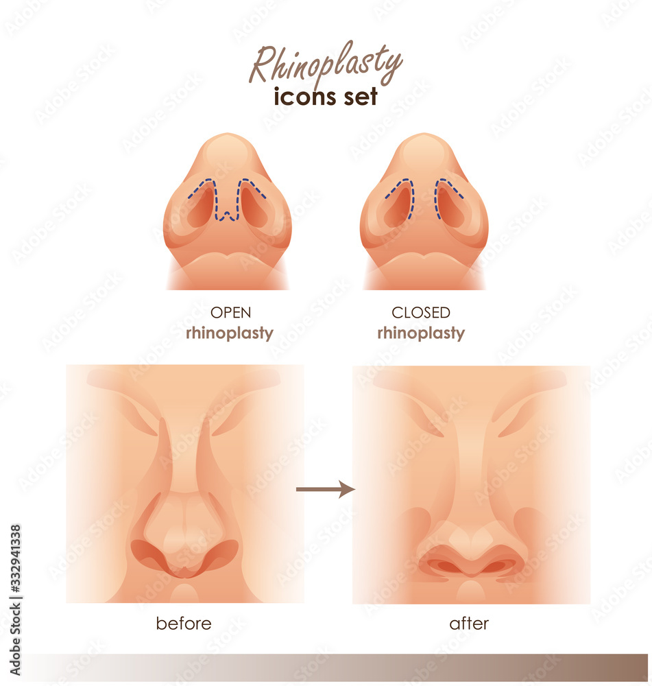 健康・医学 Closed rhinoplasty 健康・医学 Closed rhinoplasty Closed rhinoplasty. Total