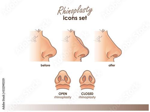Rhinoplasty. Open and closed rhinoplasty. Side and bottom view. Plastic surgery nose. Medical and beauty illustration