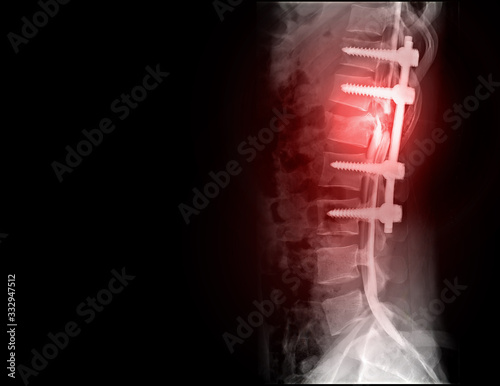 myelography is particularly sensitive at detecting small disk herniations compressing nerves of the spine . photo