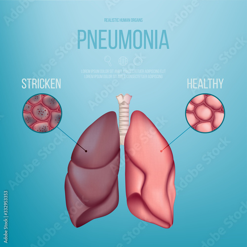Image of a healthy lung and a lung affected by pneumonia. Vector illustration. A coronavirus that causes pneumonia. Lungs of patients with pneumonia. Realistic illustration.