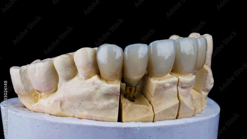 Fototapeta premium high-quality veneers and crowns for a dental model, shot on a black background