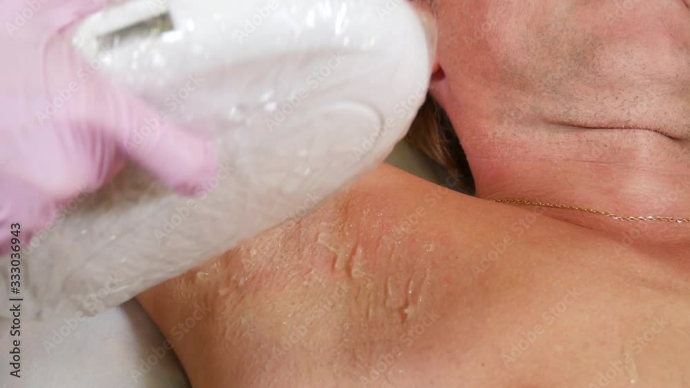 Laser hair removal procedure for young man. Laser hair removal procedure for young man.