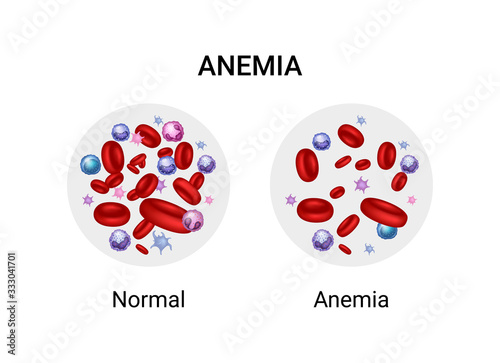 Vector illustration of the difference of number of healthy red blood cells. Anemia and normal.