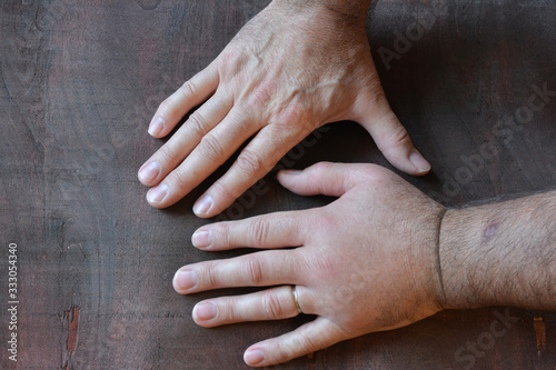 Swollen fist compared with healthy fist